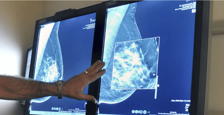 Yapay Zeka, Meme Kanseri Taramasında Radyologlara Yardımcı Olabilir mi?